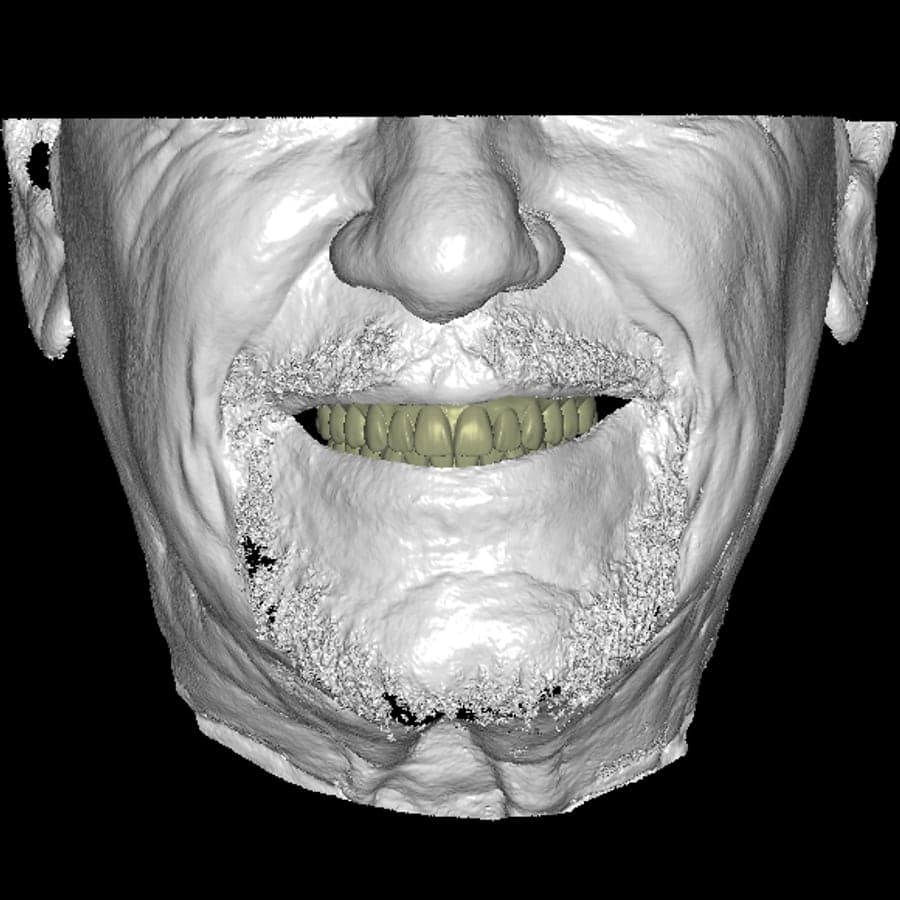 A 3D face scan of the patient with the proposed final teeth designed in, ready for the doctor to approve