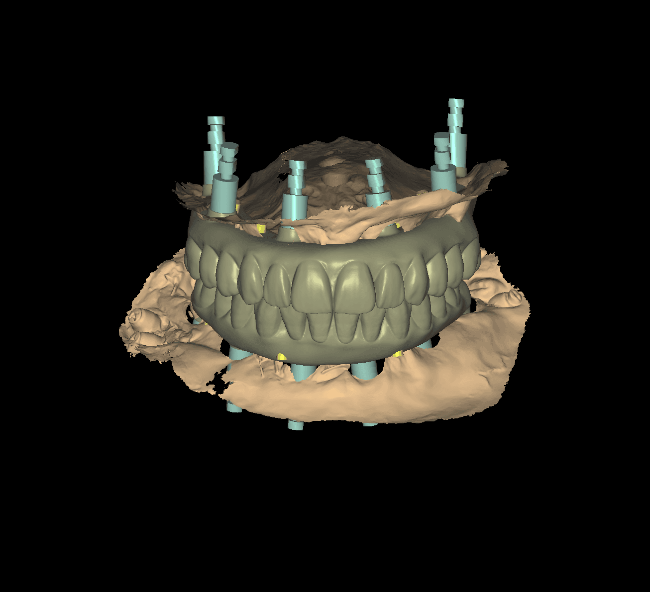 A stackable surgical guide seated with photogrammetry-verified implant positions