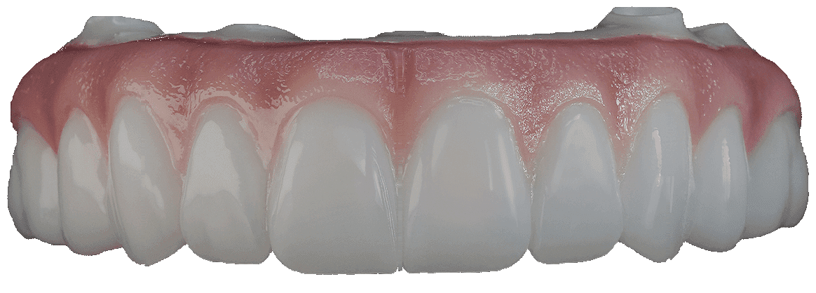 A finished full-arch implant prosthesis made at Vertex Dental Studio