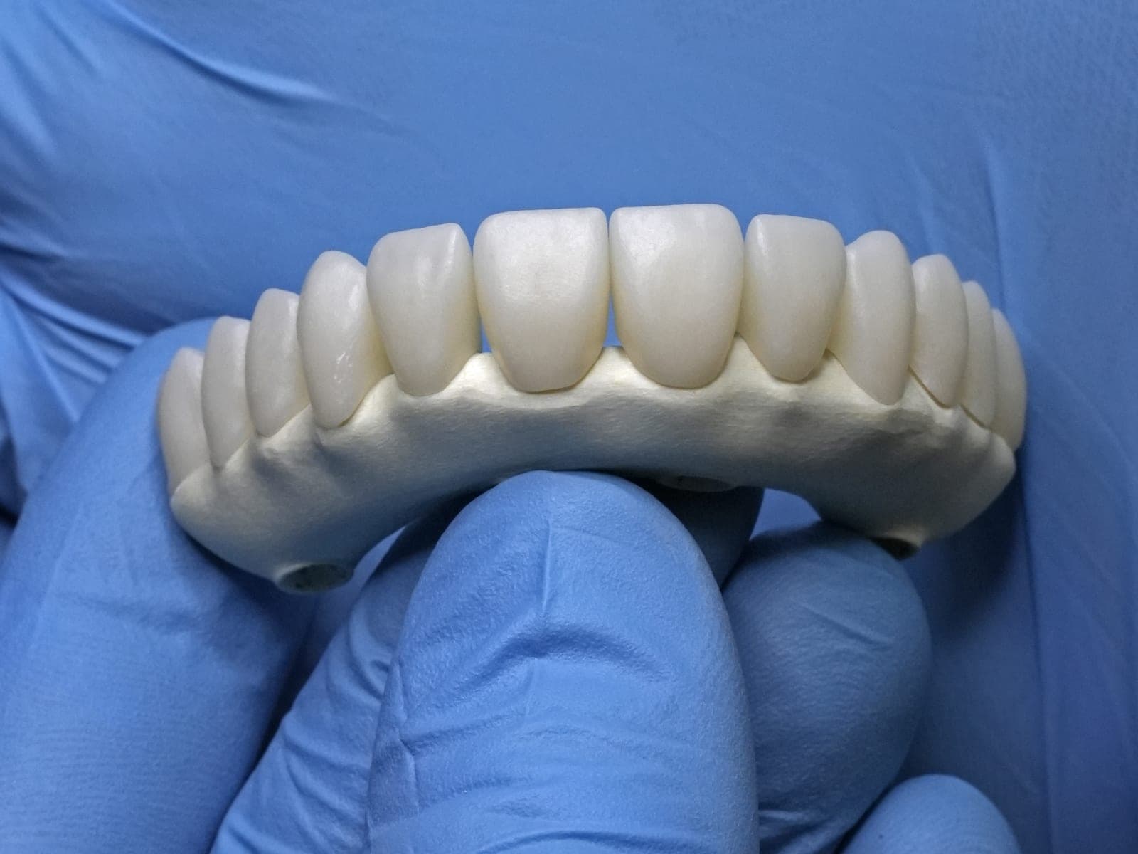 A full-arch framework with thimble crowns, held in a gloved hand